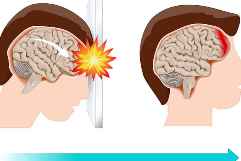 how to know if you have a concussion
